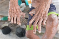 Hand injuries from leprosy -